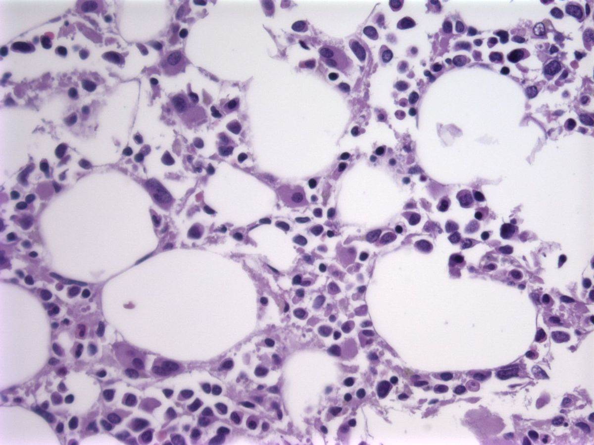 bone marrow biopsy, H&E; abnormal megakaryocytes and increased blasts